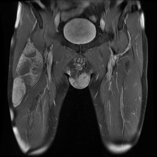 Thigh sarcoma